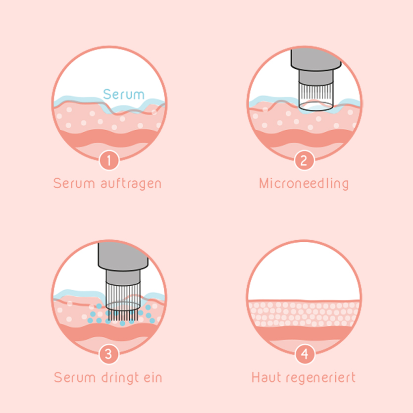 Illustration Microneedling